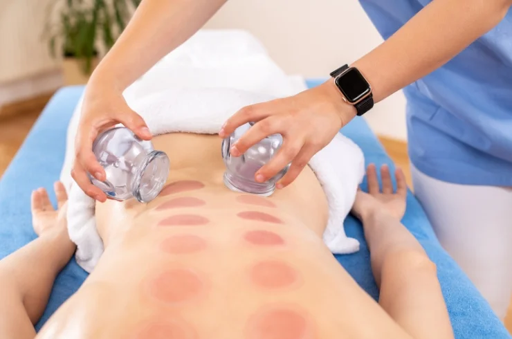 Cupping Therapy (Regular & Fire Cupping)